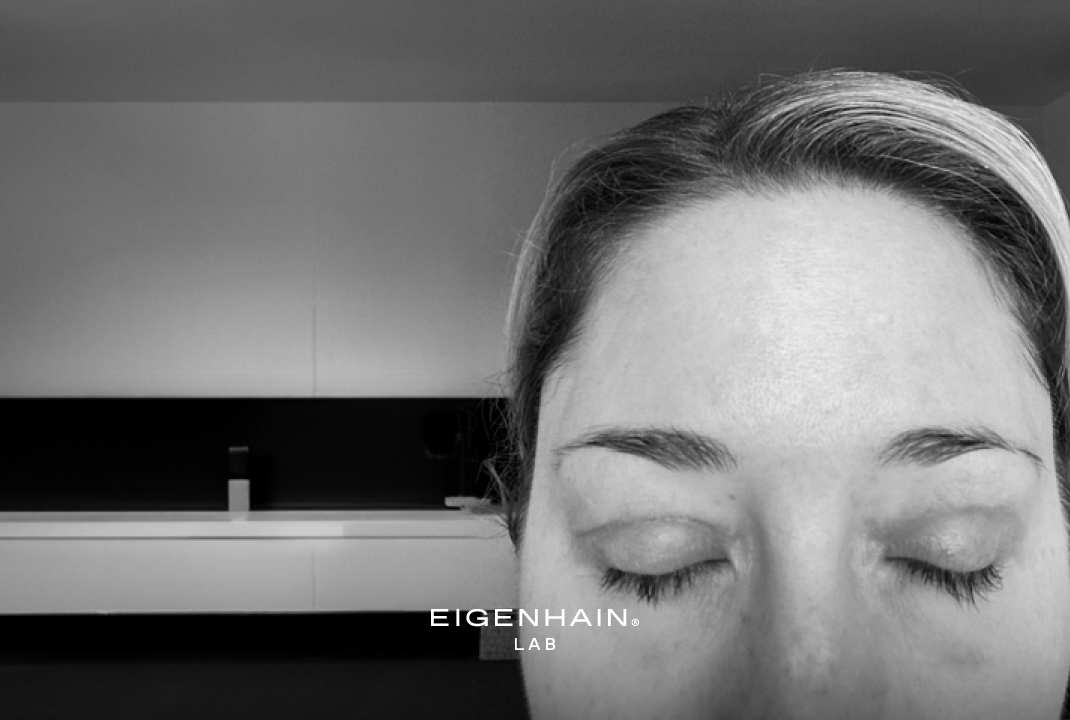 Narbenpflege nach OP - Erfahrung nach einer Oberlidstraffung (Augenlidstraffung)