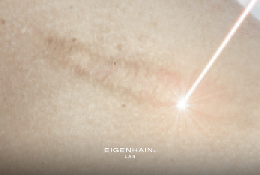 Laserbehandlungen - Nachsorge für effektive Ergebnisse | Hautexpertin erklärt