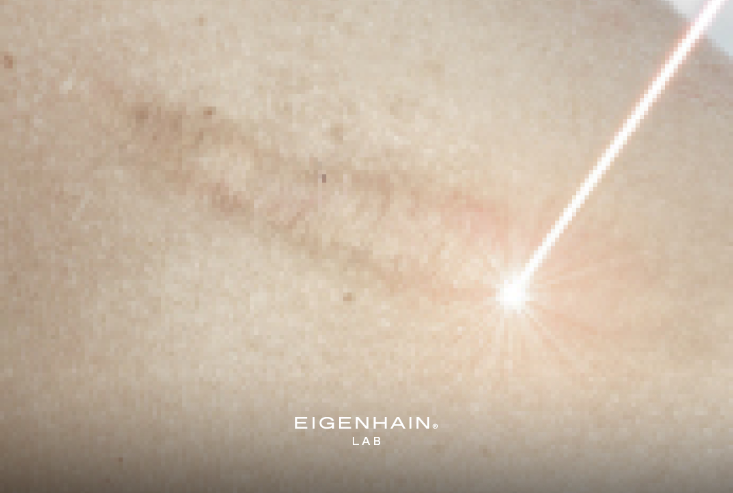Laserbehandlungen - Nachsorge für effektive Ergebnisse | Hautexpertin erklärt