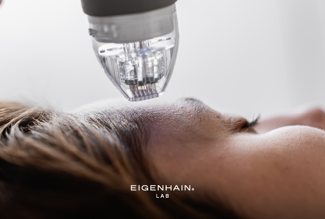 Narben, Falten, Pigmentflecken mit Microneedling behandeln: Worauf ist zu achten?
